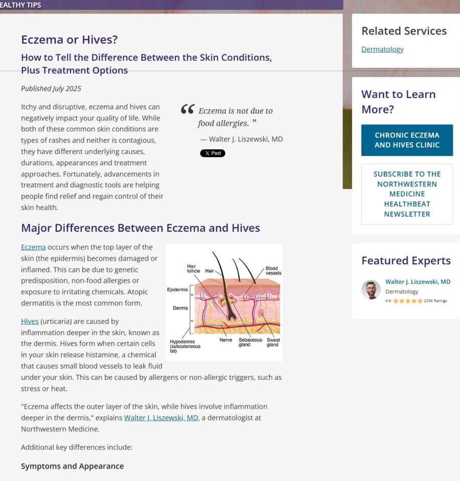 Screenshot of the published Eczema or Hives article on Northwestern Medicine's website, dated July 2025.